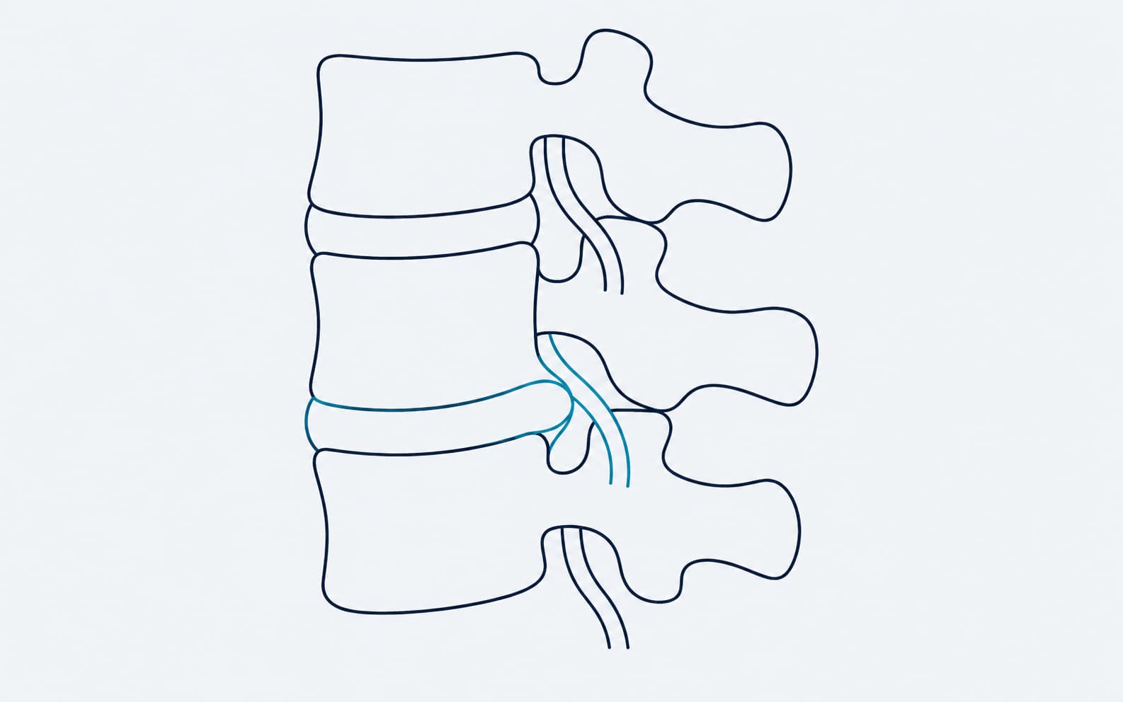 Diagrama de hernia de disco lumbar: el disco desplazado comprime la raíz nerviosa