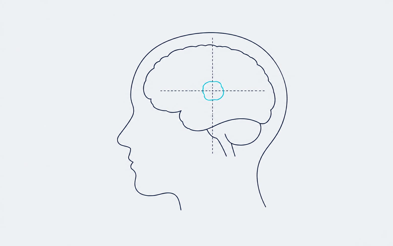 Diagrama de localización de un tumor cerebral con neuronavegación