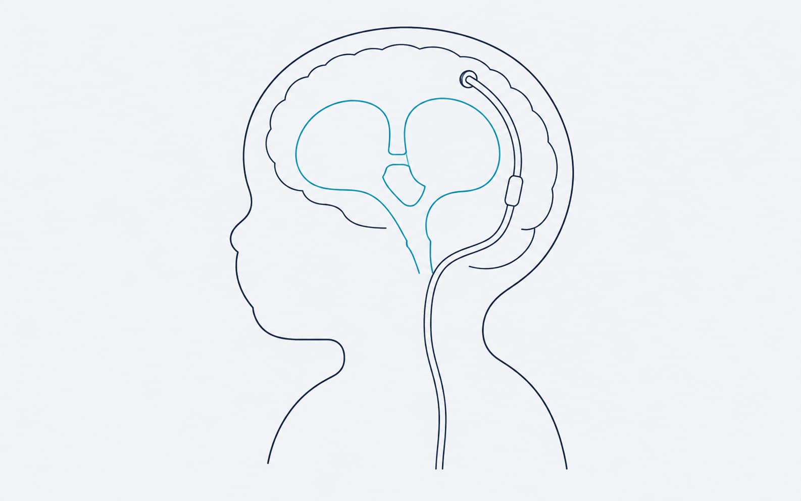 Diagrama ilustrativo de hidrocefalia infantil con ventrículos cerebrales aumentados y una derivación